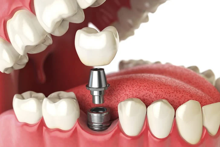 Wie Man Günstige Zahnimplantate Findet